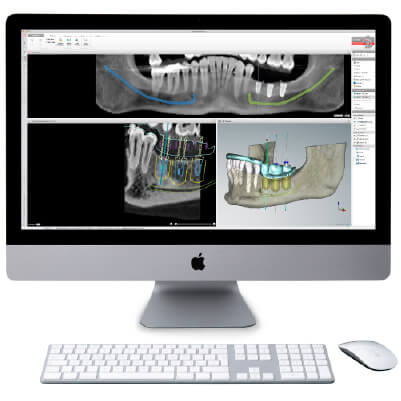 3Dシュミレーションを用いた治療計画